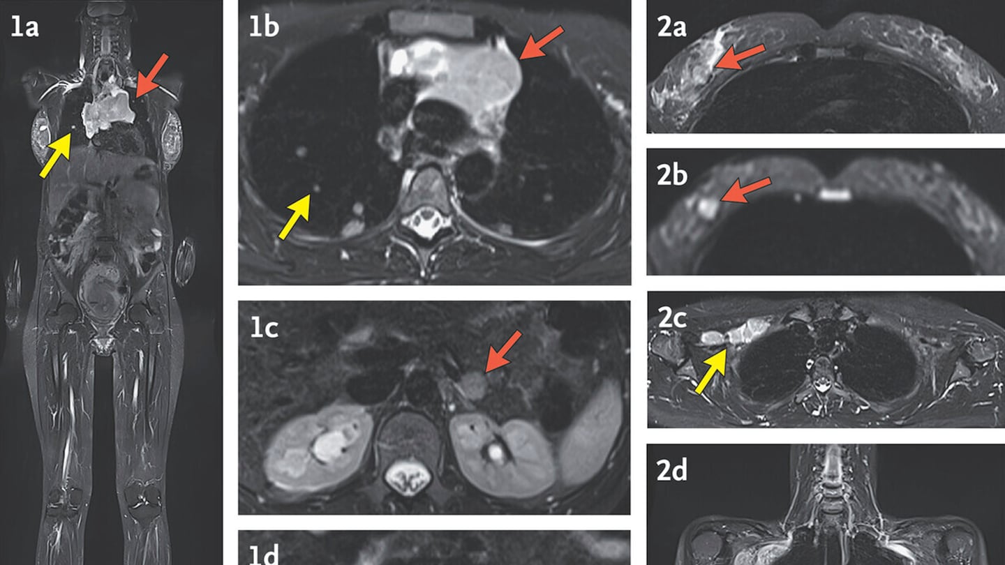 These MRI images, with arrows indicating cancer, were made during a study by researchers at the National Institutes of Health and published Wednesday in the New England Journal of Medicine.